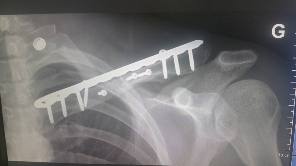 Steve D’Elia rentre de Brno avec une clavicule cassée